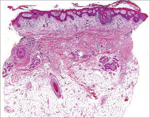 Vertical section. Note the marked reduction in hair follicle density and how follicles have been replaced by fibrous tracts.