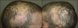 Bilateral parietal and temporal alopecic plaques.