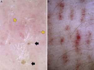 Dermoscopic findings in Pelagia noctiluca stings. Brownish crust and Linear purpura. (A) Pinpoint brownish crusts (black arrows) and red dots (orange arrows) in a pinkish hue background. (B) “Linear purpura”: linear bands composed of red dots regularly spaced in a tabby pattern.