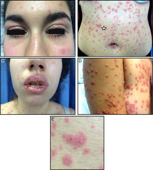 A, Bilateral conjunctival hyperemia with discharge. B, Irregular, edematous erythematous papules with central vesicles and an erythematous halo, forming palpable atypical target lesions, widespread over the face, trunk, limbs, and perineal and genital mucosas, without affecting the palms and soles. C, Erosions, confluent ulcers, and scabs on the lips and mucosa. D, Changes in the skin lesions 2 days after onset of the rash. E, Detail of the atypical target lesions (corresponds to the area of the star in image B).