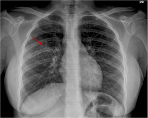 Pneumonia infiltrate in the right upper lobe (arrow).