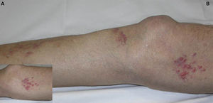 Case 2. A, Detail of grouped erythematous papules. B, Erythematous papules on the lower limb.