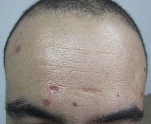 Erythematous papules with an atrophic central zone, situated in the frontal region.
