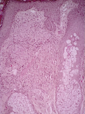 Granulomatous inflammatory infiltrate formed of histiocytes and occasional Langhans-type giant cells. Hematoxylin and eosin, original magnification ×10.