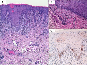A, Histologic findings: lichenoid dermatitis with effacement of the basal layer, exocytosis of neutrophils, and a band-like lymphoplasmacytic infiltrate together with numerous plasma cells on the wall and around the vessels of the dermis (hematoxylin-eosin, original magnification ×10). B, Histologic findings: detailed view of perivascular plasma cells (hematoxylin-eosin, original magnification ×40). C, Positive immunohistochemical staining for Treponema pallidum.