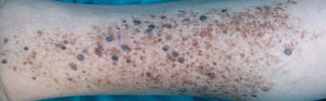 Pigmented lesion measuring 10×6cm on the posterior surface of the right lower leg. The lesion was formed of a background of a light-brown macule that contained multiple dark-brown macules and papules within its borders, together with various bluish lenticular elements.