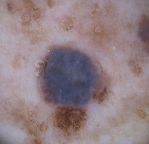 Dermoscopy image showing the collision of a blue nevus (presenting a homogeneous blue pattern) with several melanocytic nevi (showing a typical globular pattern).