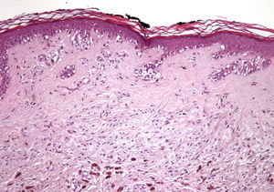Histopathology revealed a combined lesion, with findings characteristic of a blue nevus (a dermal proliferation of spindle-shaped melanocytes associated with melanophages) and findings corresponding to nevus spilus (a lentiginous proliferation of melanocytes at the dermoepidermal junction and nests of melanocytes with no atypia in the superficial dermis). Hematoxylin and eosin, original magnificationx10.