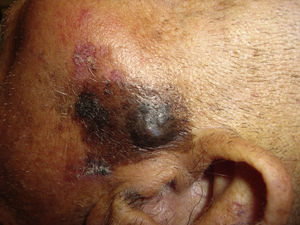Clinical image: pigmented nodular skin lesion in the left preauricular region.