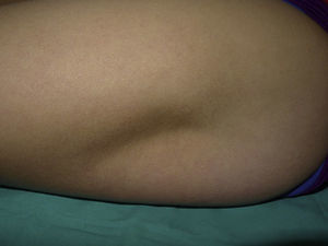 Semicircular depressed plaque measuring 9×7cm, covered with normal skin and located on the anterolateral aspect of the left thigh.