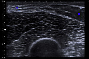Cutaneous ultrasound revealed a marked loss of subcutaneous tissue (asterisk and short arrow) in comparison to the healthy adjacent subcutaneous tissue (circle and long arrow).