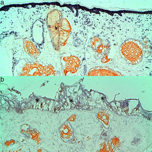 (a) Complete coagulation and wall destruction of dermal vessels with preserved epidermis in the histochemical analysis. The histological picture corresponds to the green circle in Fig. 3. (b) High fluences lead to intense epidermal (*) and dermal tissue damage. Note the permanent gray in the central area following treatment with high fluence (Fig. 3, red circle).