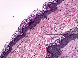 Hematoxylin-eosin, original magnification ×10. Inset at lower right, hematoxylin-eosin, original magnification ×20.