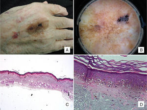 Patient #2: An 88-year-old man with a pigmented macule present on his hand for years. A, Pigmented macule with asymmetric morphology and pigmentation. B, Dermoscopic image showing annular-granular pigmentation at one of the borders, together with rhomboidal structures and areas of regression. C, Histologic image of excised lesion showing proliferation of single melanocytes surrounded by a light halo in sun-damaged skin (marked solar elastosis) in addition to epidermal atrophy (hematoxylin-eosin, original magnification ×20). D, A higher-magnification view shows a proliferation of epithelioid cells with a pagetoid distribution and subepidermal fibrosis (hematoxylin-eosin, original magnification ×200).
