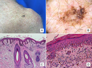 Patient #4: A 63-year-old man with a pigmented lesion on the scapula. A, A 13-mm pigmented macule on the left scapula. B, Dermoscopic image showing asymmetric follicular pigmentation, rhomboidal structures, and some obliterated follicular openings. Note also the features typically associated with superficial spreading melanoma, such as the atypical network, regression areas, and a blue-white veil. C, Proliferation of solitary and small nests of epithelioid melanocytes in the epidermis, with an accompanying inflammatory infiltrate, involvement of the adnexal epithelium, and solar elastosis (hematoxylin-eosin, original magnification ×100). D, A higher-magnification view shows melanophages in the papillary dermis (hematoxylin-eosin, original magnification ×200).