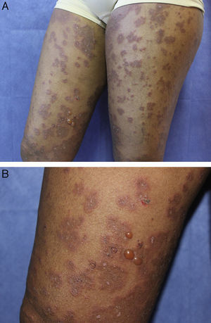 A, Annular and polycyclic erythematous plaques with tense peripheral blisters on both thighs. B, Detail of the same lesions.