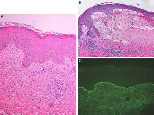 A, Vacuolization of the basal layer of the epidermis with no clear evidence of vesicles or blisters, and the presence of a superficial and deep dermal inflammatory infiltrate with lymphocytes and occasional eosinophils. Hematoxylin and eosin, original magnification×20. B, Subepidermal blister containing fibrin and abundant eosinophils, and a dermal infiltrate of lymphocytes and eosinophils. Marked subepidermal edema is observed close to the blister with early separation of the dermoepidermal junction. Hematoxylin and eosin, original magnification×20.C, Positive direct immunofluorescence with linear deposits of immunoglobulin G and C3 at the dermoepidermal junction.