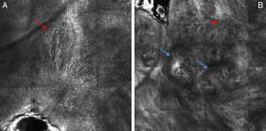 Confocal microscopy. A, Focus of abundant dendritic cells in the epidermis (red arrow). B, Areas of poorly defined papillas, with atypical junctional and dermal nests (blue arrows), areas of fibrosis, and an inflammatory infiltrate (asterisk).