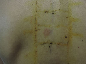 Positive allergic reaction to capryloyl salicylic acid.