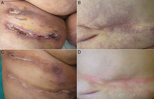 A, Calciphylaxis-related skin ulcers on the anterior aspect of the thighs. B, Livedo racemosa and retiform purpura on the abdomen. C, Healing of the ulcers on the anterior aspect of the thighs after combined treatment with intravenous sodium thiosulfate and alprostadil. D, Disappearance of the livedo racemosa and retiform purpura on the abdomen.