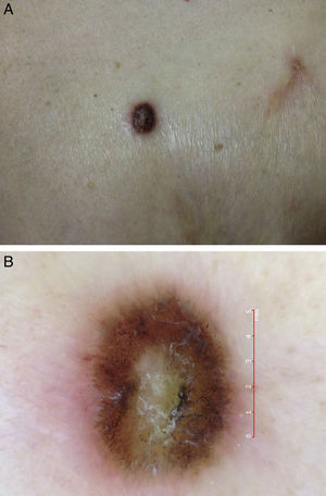 A, Image of the black tumor with a keratotic surface on an erythematous base. B, Central hypopigmentation, radial projections, and peripheral globules. Tortuous vessels are visible at the lower pole.
