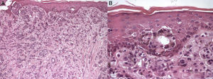Histopathology. A, Glandular structures of adenocarcinoma of the breast. Hematoxylin and eosin, original magnification×10. B, Pigment can be observed in the superficial tumor cells and in the superficial dermis. Hematoxylin and eosin, original magnification×10.