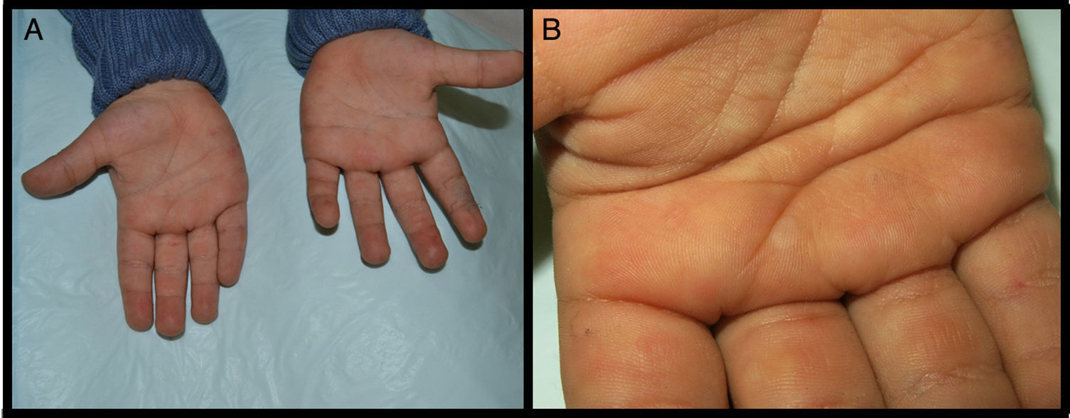 Acral Peeling Skin Syndrome: A Case Report and Literature Review ...