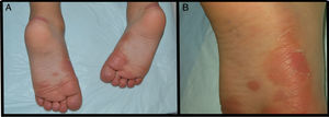 Blisters and peeling on the soles of the feet and in pressure areas. A, General view. B, Detail of the lesions.