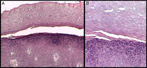 A, Separation between the corneal and granular layers of the epidermis. Hematoxylin and eosin (H&E), original magnification×10. B, Detail at higher magnification. Observe the appearance of the corneal layer above the plane of separation, with large round cells. H&E, original magnification×20.
