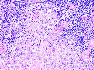 Histiocytes with basophilic granular cytoplasm corresponding to the aluminum component of a vaccine, intermixed with lymphocytes, together with eosinophils and plasma cells (hematoxylin-eosin, original magnification ×40).