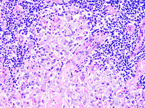 Histiocytes with basophilic granular cytoplasm corresponding to the aluminum component of a vaccine, intermixed with lymphocytes, together with eosinophils and plasma cells (hematoxylin-eosin, original magnification ×40).
