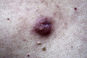 Lymphocytoma cutis. Solitary lesion on the back.
