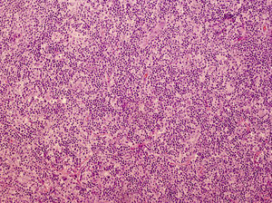 Histologic image of the lymphocytoma cutis shown in Figure 3. Dense mixed dermal infiltrate. Note the merging germinal centers devoid of the mantel zone, simulating a B-cell lymphoma (hematoxylin-eosin, original magnification ×20).