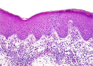 Lymphomatoid contact dermatitis. In this patient sensitized to methylchloroisothiazolinone and colophony, histology showed a band-like lymphocytic infiltrate and in some areas without spongiosis, clusters in the epidermis reminiscent of Pautrier microabscesses.