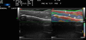 Strain elastography of a nail. The nail plate (T) is stiffer than the nail bed (L) and similar in stiffness to the distal phalanx (D).