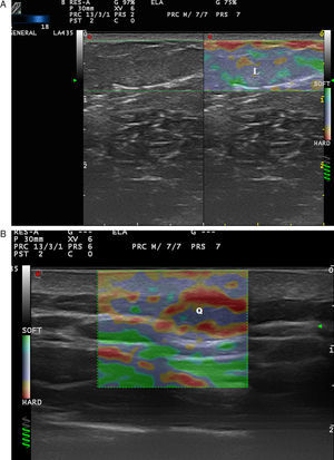 A, Strain elastography of a lipoma (L). B, Elastography of a cyst (Q).