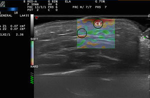 Strain elastography of a squamous cell carcinoma of the cheek (CE). The strain ratio (SR=2.36) indicates that the lesion is stiffer than the adjacent subcutaneous cellular tissue.