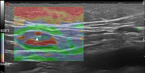 Strain elastography of an inflamed lymph node (A). Note that the medulla is stiffer than the cortex.