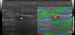 Strain elastography of a lymph node metastasis of melanoma (M). Note the complete rigidity of the lesion and the lack of soft areas.