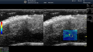 Shear wave elastography of a post-surgical inflammatory area of the scalp (blue region). On the left-hand side, note the velocities and pressures in the region of interest.