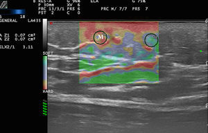 Elastography of morphea (M). An increase in stiffness can be observed in the dermal-subdermal interface of the plaque in comparison with the surrounding tissue (SR=3.4).