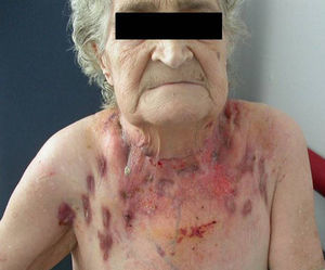 A patient with scrofuloderma, a condition referred to as lamparones (shiny, stretched swellings) in Cantiga 321. (Photograph from the archives of Hospital Parc Taulí, Sabadell, Barcelona).