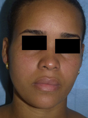 Bilateral malar erythema and edema and conjunctival injection.