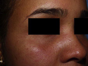 Detailed image of marked conjunctival injection.
