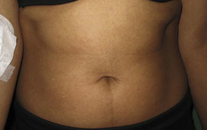 Subtle rash comprising micropapules on a background of generalized erythema.