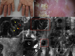 (a) Clinical picture of dyshidrotic eczema; (b) dermoscopic image disclosing erythema and scales; (c) RCM Vivablock mosaic taken at the level of the epidermis showing hyperkeratosis (white square) and clusters of intra-epidermal vesicles visible as well demarcated dark area (red squares); dark areas with the surrounding epithelium corresponding to spongiosis (asterisk); (d) RCM detail of intra-epidermal vesicle disclosing a vesicle with bright septa and bright cellular elements floating in the dark area of the vesicle (yellow arrows) and necrotic keratinocytes inside vesicle (red arrows); (e) RCM close-up of the epidermis showing an intra-epidermal vesicle (asterisk) that push the surrounding epidermis with loss of normal honey-combed pattern.