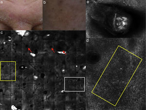 (a) Clinical image of SD involving the forehead; (b) dermoscopy showing erythema and scales with linear dilated blood vessels; (c) RCM Vivablock mosaic taken at the level of epidermis shows up migrated rimmed dermal papillae (white square), spongiosis (yellow square), sebaceous glands (red arrows) and adnexal structure with bright material inside corresponding to demodex folliculorum (asterisks); (d) RCM close up taken at the level of the epidermis reveals spongiosis associated with the presence of numerous inflammatory cells composed by small, reflactile, roundish cells corresponding probably to lymphocytes (yellow square) focally located around adnexal structure; (e) RCM detail of multiple roudish bright structures inside adnexal structure corresponding to posterior extremity of demodex folliculorum.