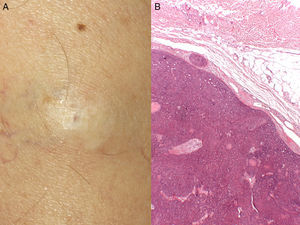 A, Hard, whitish nodule measuring 25mm in diameter. The nodule, situated in the left thigh, was not adherent to deeper planes. B, Proliferation of basaloid cells with no retraction cleft with the stroma. Hematoxylin and eosin, original magnification×4.