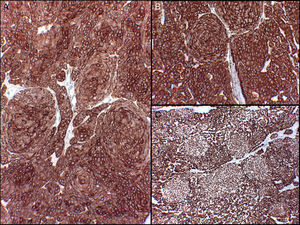 Positive immunohistochemistry with no differences between the 2 cell types. A, Stain for pancytokeratins AE1/AE2. B, Stain for cytokeratin 5/6. C, Stain for p63.
