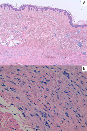 A, Dermal proliferation of spindle-shaped cells in interwoven bundles running parallel to the skin surface. Hematoxylin and eosin, original magnification×40. B, Detail of the cells with wavy, elongated nuclei and a rounded outline. Hematoxylin and eosin, original magnification×400.
